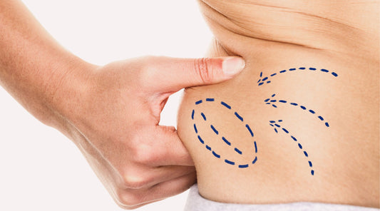 The Risks and Rewards of Liposuction