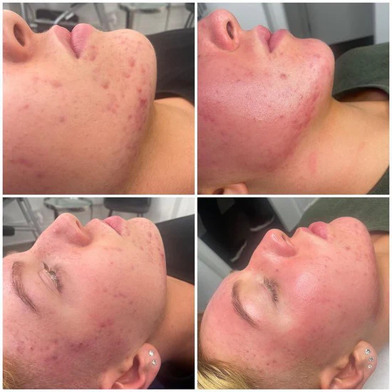 Before and after LED therapy — acne clearing results