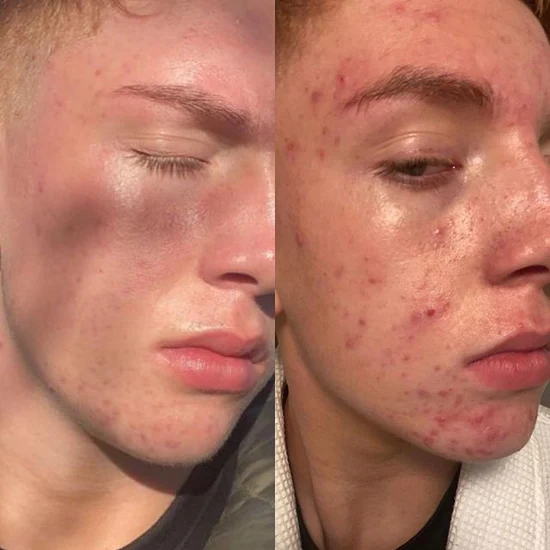 Before and after LED therapy — dramatic acne clearing over 12 weeks